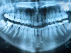 Digital Dental X-Rays