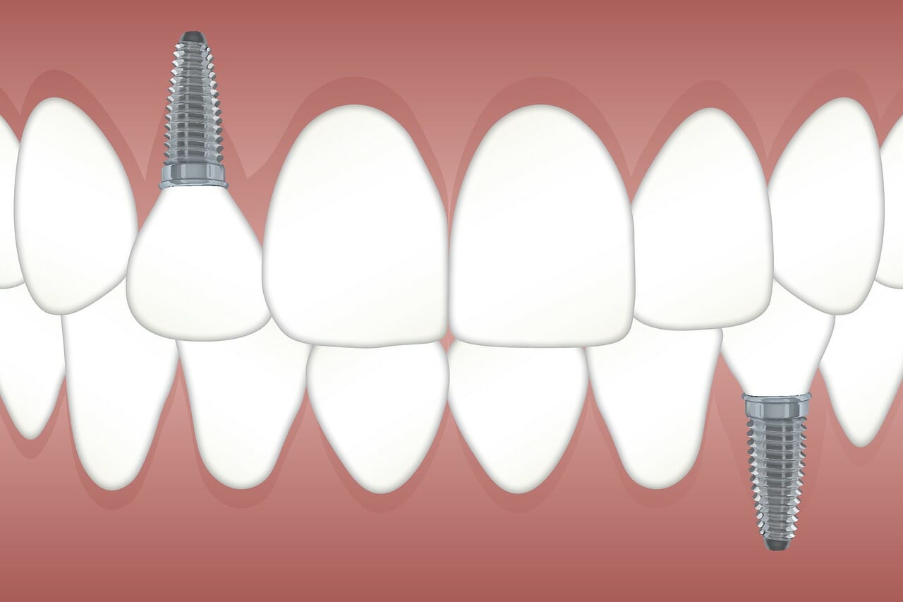 What to Expect Following Dental Implants